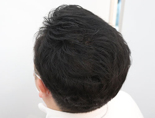 頭頂部／After