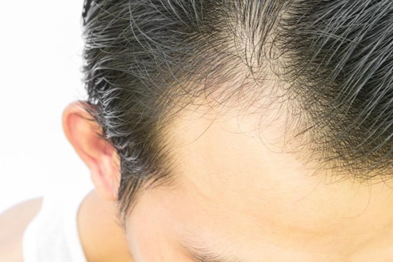 【毛髪診断士監修】頭皮の色は「青」「白」「黄」「赤」「茶」どれが健康？正しいケアを紹介