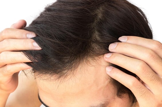【毛髪診断士監修】頭皮の皮脂の原因は？起こり得るトラブルや皮脂を抑える方法を紹介